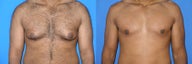 Male breast reduction