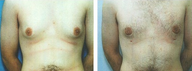Male breast reduction
