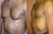 Male breast reduction