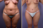 Mommy makeover