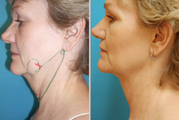Neck lift