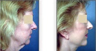 Neck lift