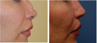 Non surgical nose job