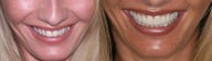 Porcelain veneers