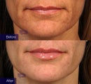 Restylane