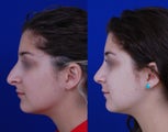 Revision rhinoplasty