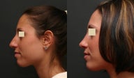 Rhinoplasty