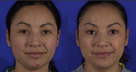 Rhinoplasty