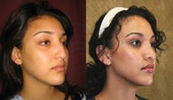 Rhinoplasty