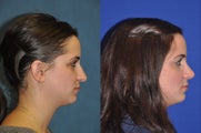 Rhinoplasty