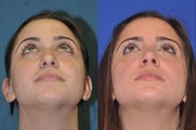 Rhinoplasty