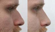 Non surgical nose job
