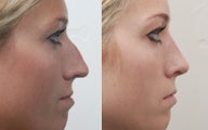 Rhinoplasty