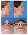 Rhinoplasty