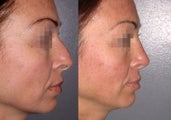 Rhinoplasty