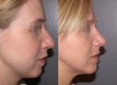 Rhinoplasty