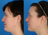 Rhinoplasty