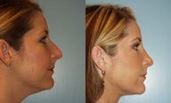 Rhinoplasty