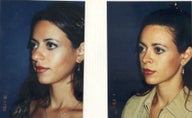 Rhinoplasty