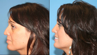 Rhinoplasty