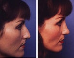 Rhinoplasty