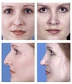 Rhinoplasty