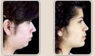 Rhinoplasty