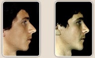 Rhinoplasty