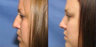 Rhinoplasty