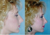 Rhinoplasty