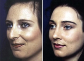 Rhinoplasty