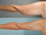 smartlipo