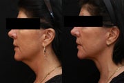 SmartLipo MPX