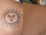 Tattoo removal