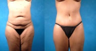 Tummy tuck
