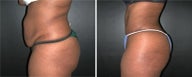 Tummy tuck