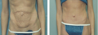 Tummy tuck