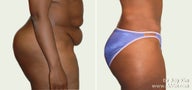 Tummy tuck