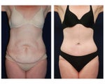 Tummy tuck