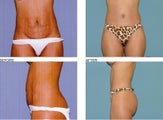 Tummy tuck