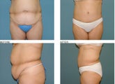 Tummy tuck