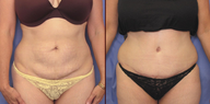 Tummy tuck