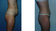 Tummy tuck