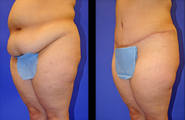 Tummy tuck