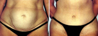 Tummy tuck