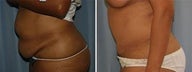 Tummy tuck