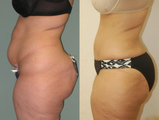 Tummy tuck