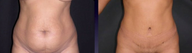 Tummy tuck