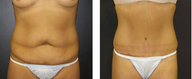 Tummy tuck