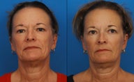 Ultherapy